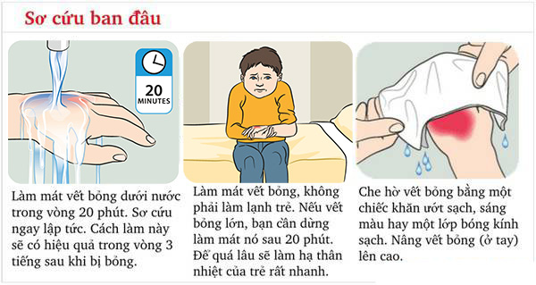 Sơ cứu khi trẻ bị bỏng